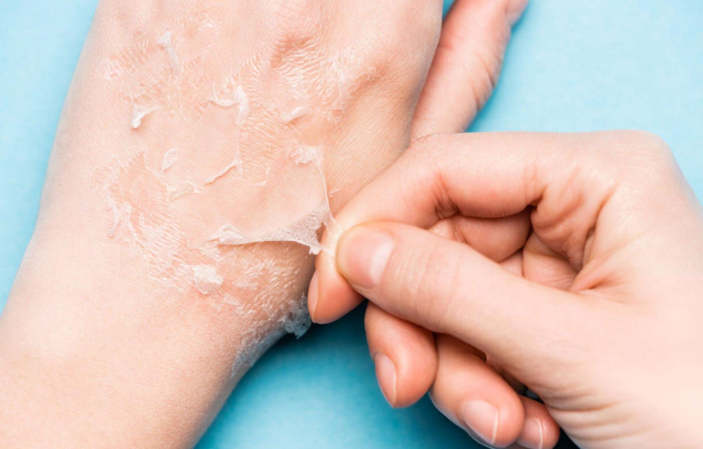 EXO–NAD peel results